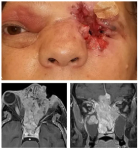 7NDEMP02 Patient Management in Advanced Collision Tumour: Surgical, Postoperative, and Prosthetic Rehabilitation Considerations